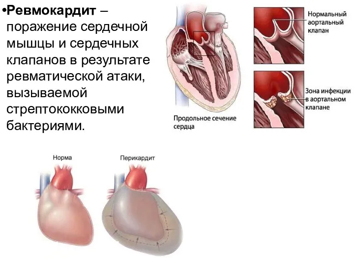 Ревмокардит – поражение сердечной мышцы и сердечных клапанов в результате ревматической атаки, вызываемой стрептококковыми бактериями.