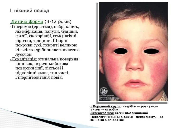 Дитяча форма (3-12 років) ІІ віковий період -Гіперемія (еритема), набряклість,