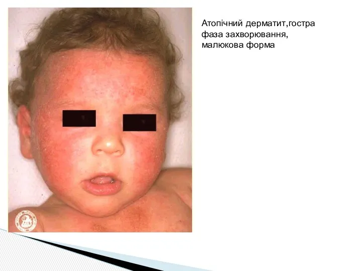 Атопічний дерматит,гостра фаза захворювання, малюкова форма