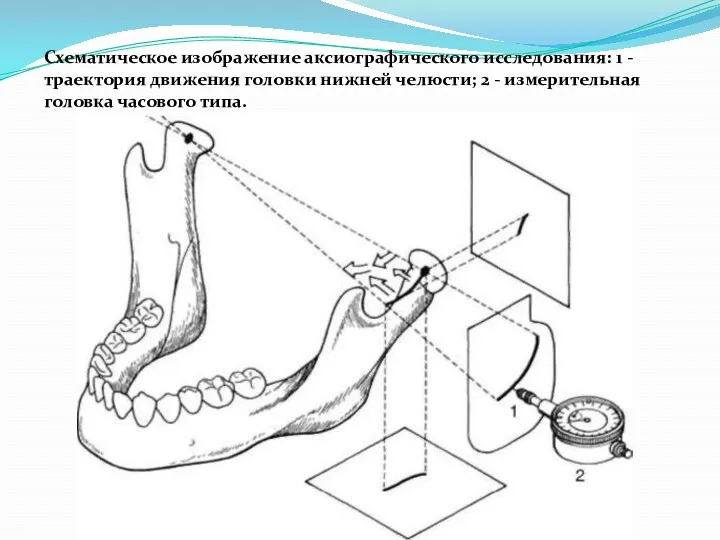 Схематическое изображение аксиографического исследования: 1 - траектория движения головки нижней челюсти; 2 -