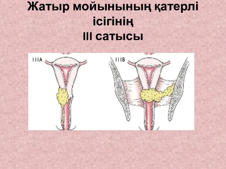 Жатыр мойынының қатерлі ісігінің III сатысы