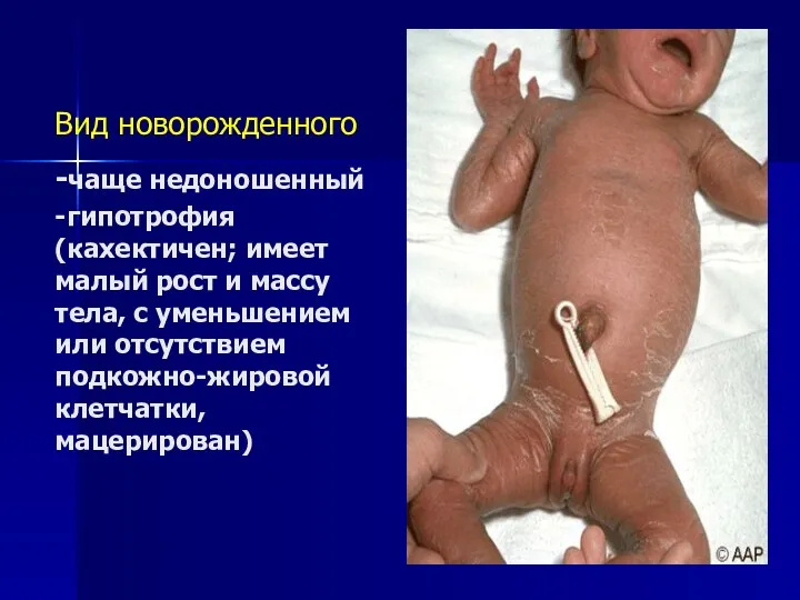 Вид новорожденного -чаще недоношенный -гипотрофия (кахектичен; имеет малый рост и