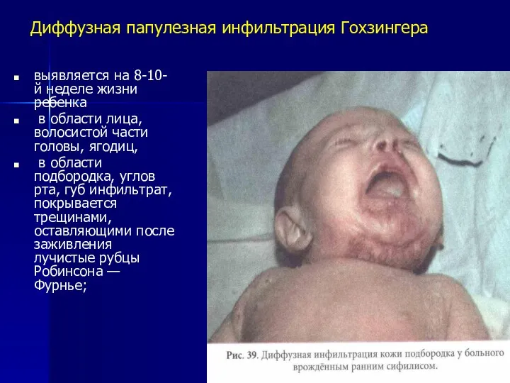 Диффузная папулезная инфильтрация Гохзингера выявляется на 8-10-й неделе жизни ребенка