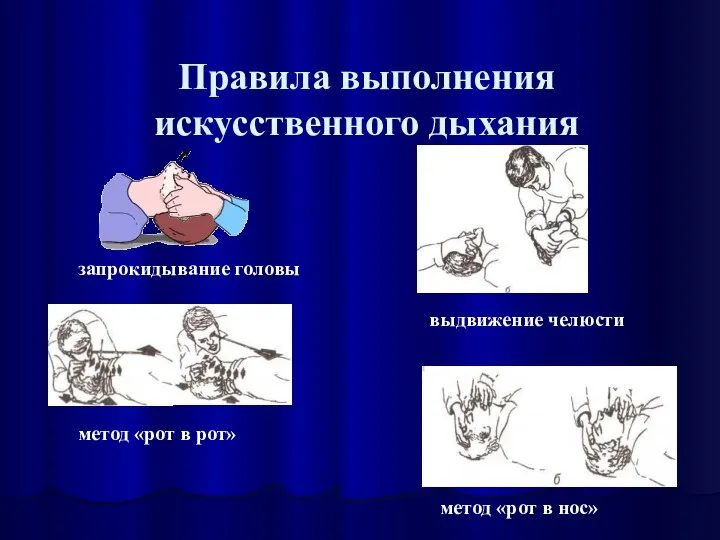 Правила выполнения искусственного дыхания метод «рот в рот» метод «рот в нос» запрокидывание головы выдвижение челюсти