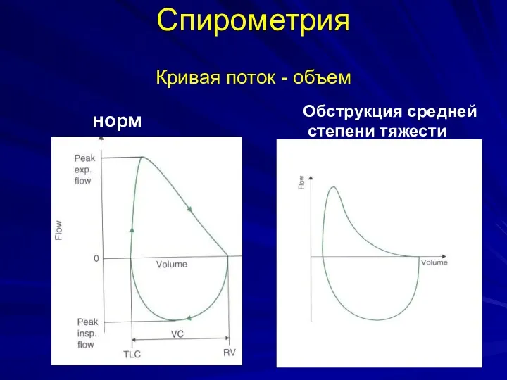Спирометрия Кривая поток - объем норма Обструкция средней степени тяжести