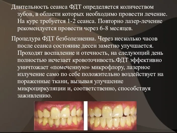 Длительность сеанса ФДТ определяется количеством зубов, в области которых необходимо