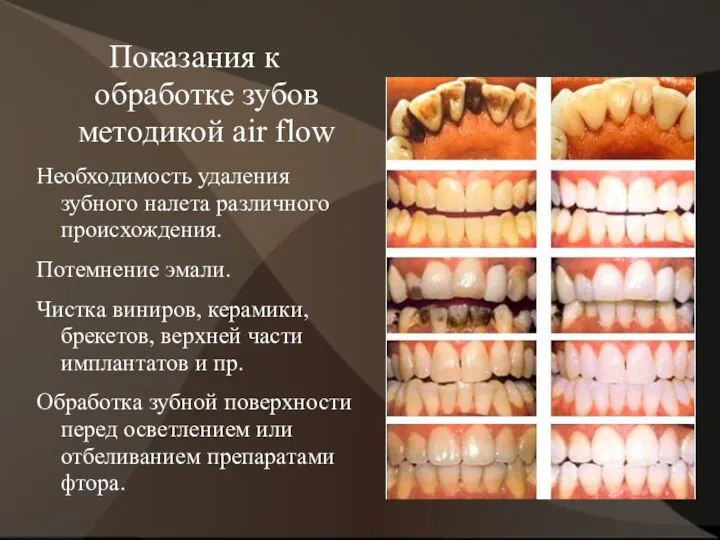 Показания к обработке зубов методикой air flow Необходимость удаления зубного