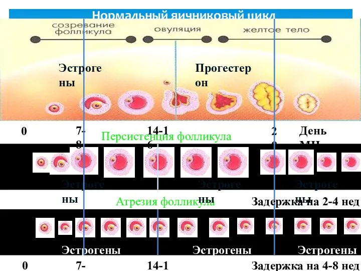 Нормальный яичниковый цикл Персистенция фолликула Атрезия фолликула Эстрогены Эстрогены Эстрогены