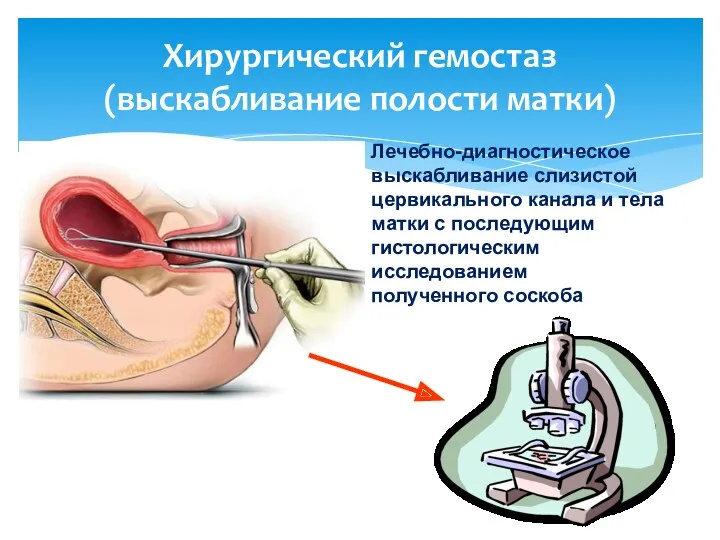 Хирургический гемостаз (выскабливание полости матки) Лечебно-диагностическое выскабливание слизистой цервикального канала