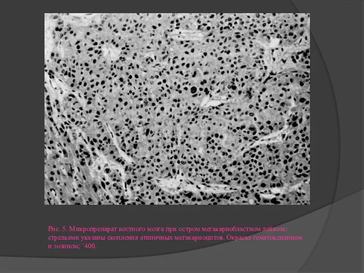 Рис. 5. Микропрепарат костного мозга при остром мегакариобластном лейкозе: стрелками