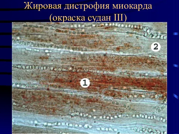 Жировая дистрофия миокарда (окраска судан III)