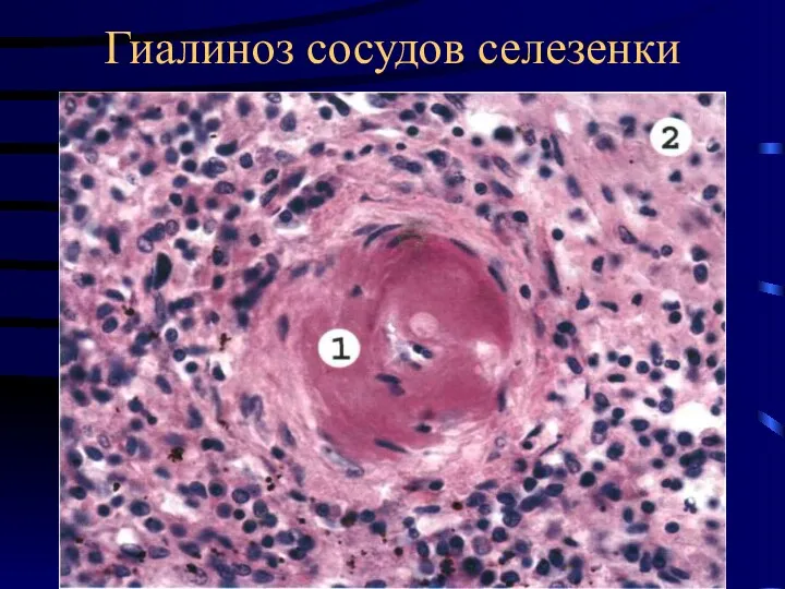 Гиалиноз сосудов селезенки