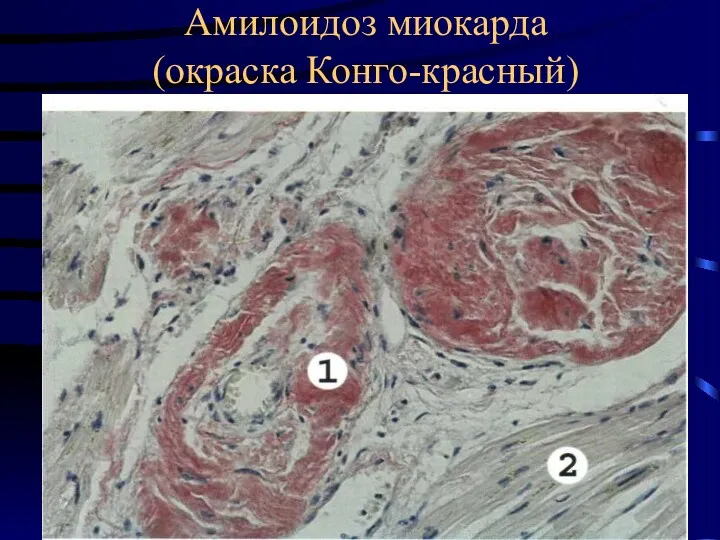 Амилоидоз миокарда (окраска Конго-красный)