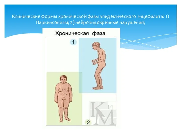 Клинические формы хронической фазы эпидемического энцефалита: 1) Паркинсонизм; 2) нейроэндокринные нарушения;