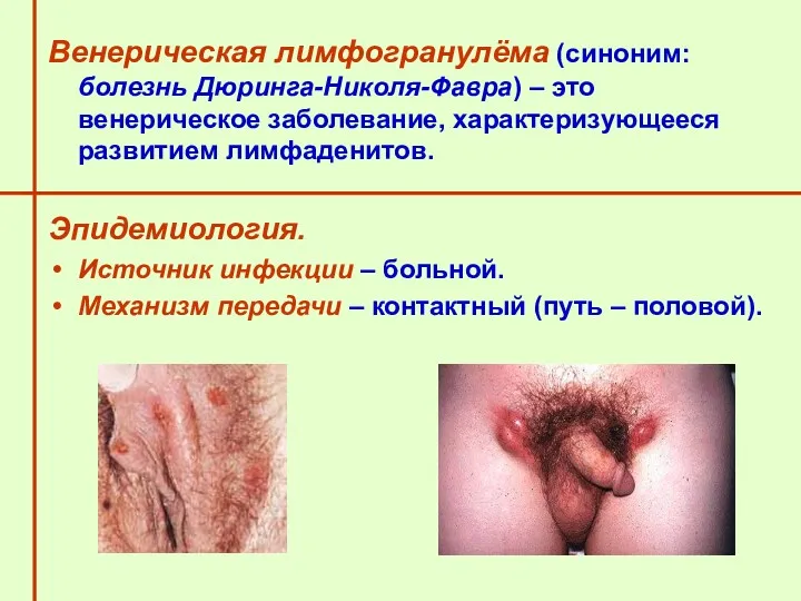 Венерическая лимфогранулёма (синоним: болезнь Дюринга-Николя-Фавра) – это венерическое заболевание, характеризующееся развитием лимфаденитов. Эпидемиология.