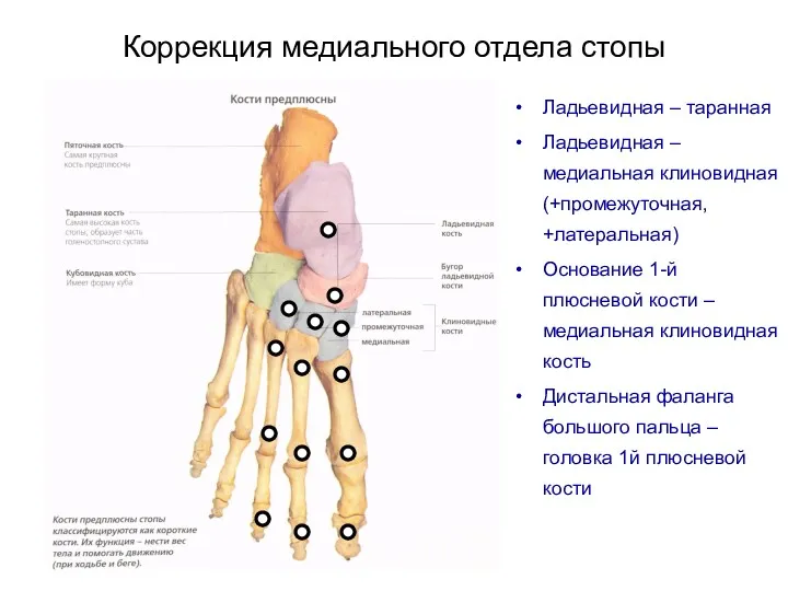 Коррекция медиального отдела стопы Ладьевидная – таранная Ладьевидная – медиальная