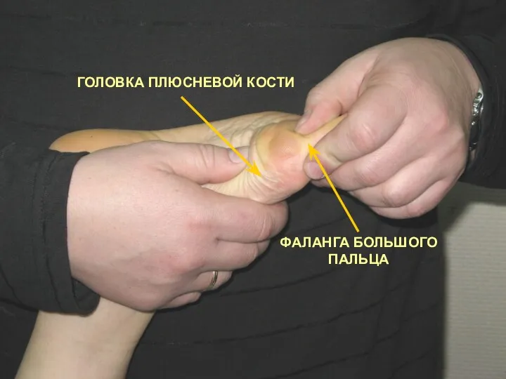 ГОЛОВКА ПЛЮСНЕВОЙ КОСТИ ФАЛАНГА БОЛЬШОГО ПАЛЬЦА