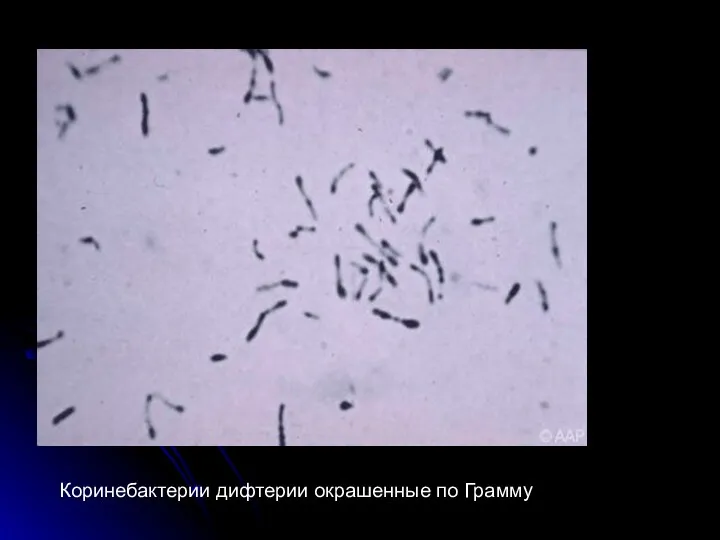 Коринебактерии дифтерии окрашенные по Грамму