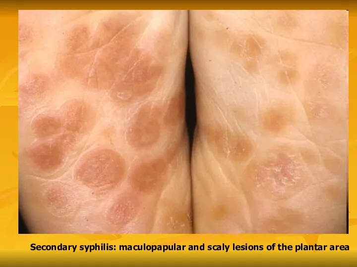 Secondary syphilis: maculopapular and scaly lesions of the plantar area