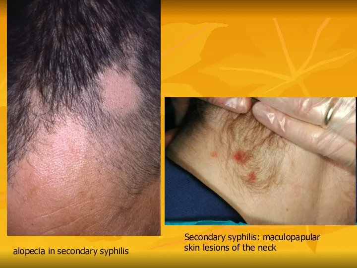 alopecia in secondary syphilis Secondary syphilis: maculopapular skin lesions of the neck