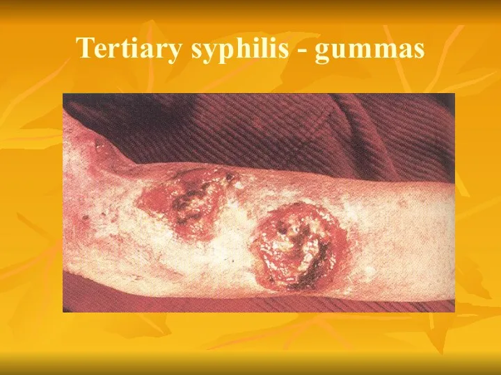 Tertiary syphilis - gummas