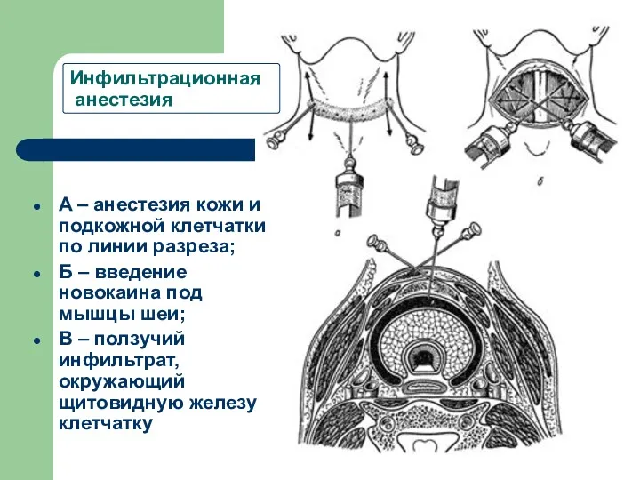 Инфильтрационная анестезия A – анестезия кожи и подкожной клетчатки по