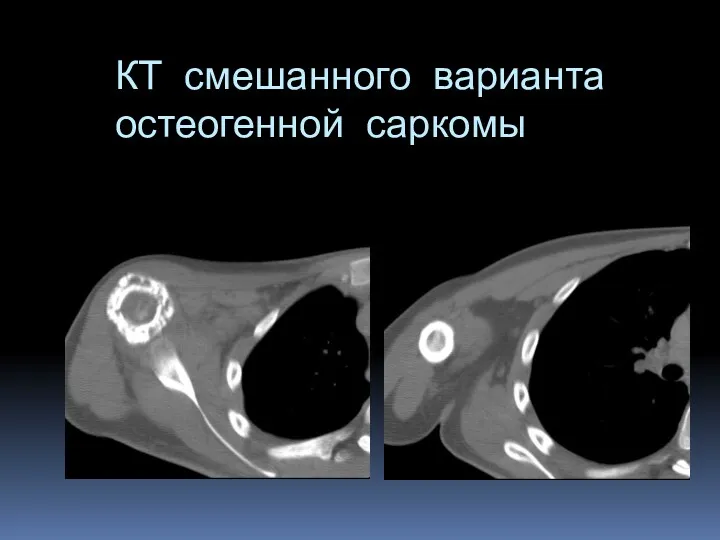 КТ смешанного варианта остеогенной саркомы