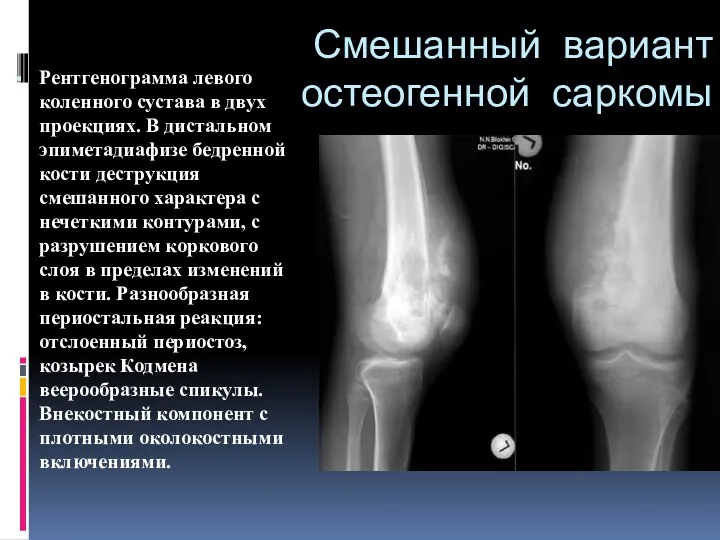 Смешанный вариант остеогенной саркомы Рентгенограмма левого коленного сустава в двух