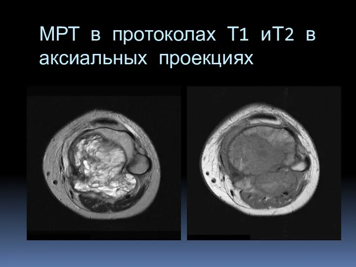 МРТ в протоколах Т1 иТ2 в аксиальных проекциях