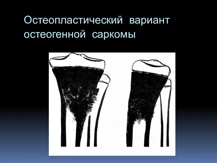 Остеопластический вариант остеогенной саркомы