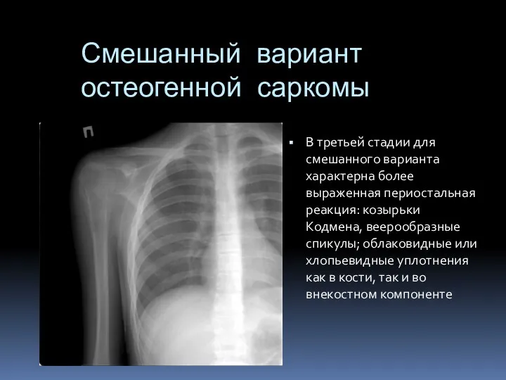 Смешанный вариант остеогенной саркомы В третьей стадии для смешанного варианта характерна более выраженная