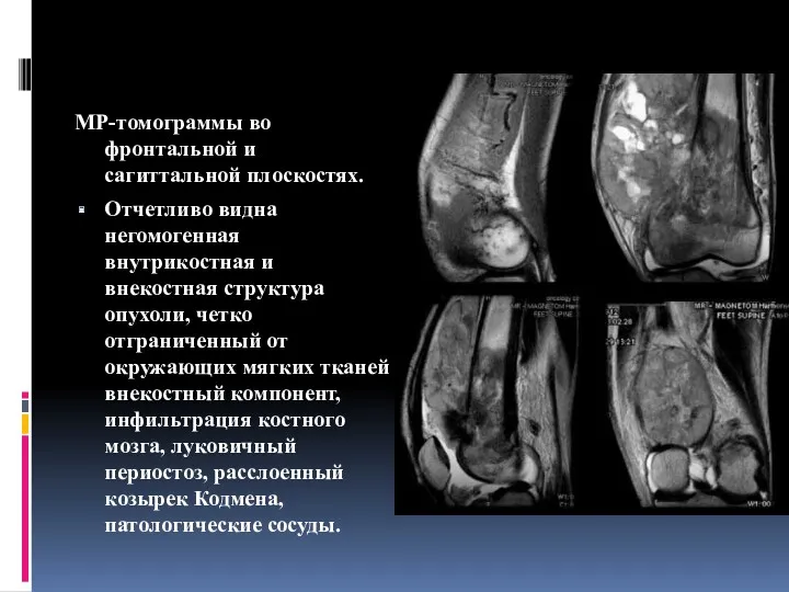 МР-томограммы во фронтальной и сагиттальной плоскостях. Отчетливо видна негомогенная внутрикостная и внекостная структура