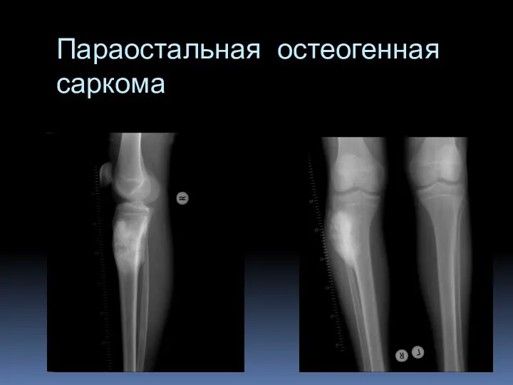 Параостальная остеогенная саркома