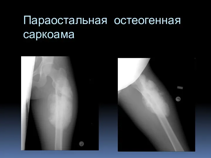 Параостальная остеогенная саркоама