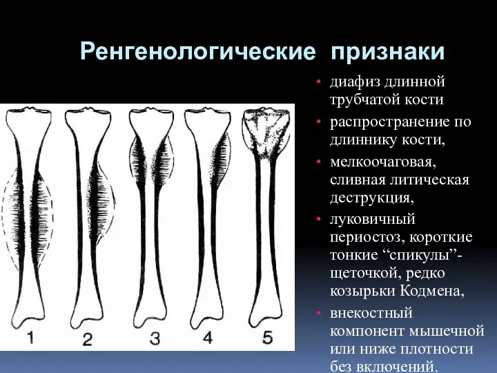 Ренгенологические признаки диафиз длинной трубчатой кости распространение по длиннику кости, мелкоочаговая, сливная литическая