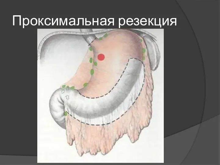 Проксимальная резекция