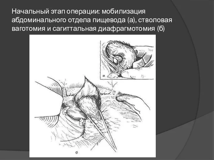 Начальный этап операции: мобилизация абдоминального отдела пищевода (а), стволовая ваготомия и сагиттальная диафрагмотомия (б)