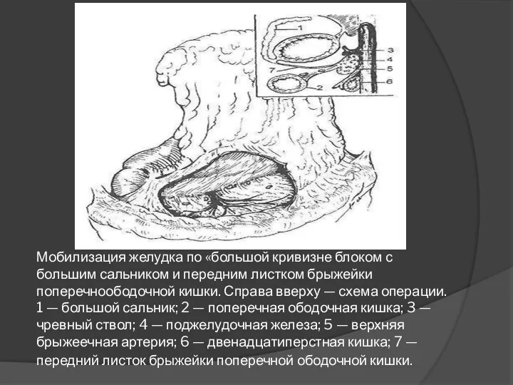 Мобилизация желудка по «большой кривизне блоком с большим сальником и