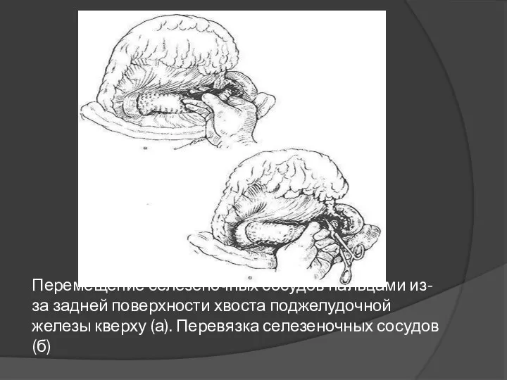 Перемещение селезеночных сосудов пальцами из-за задней поверхности хвоста поджелудочной железы кверху (а). Перевязка селезеночных сосудов (б)