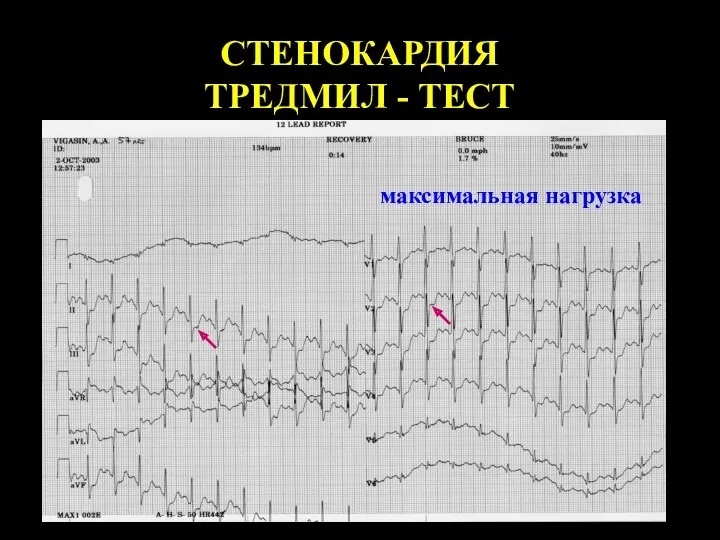 СТЕНОКАРДИЯ ТРЕДМИЛ - ТЕСТ максимальная нагрузка