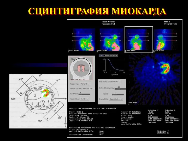 СЦИНТИГРАФИЯ МИОКАРДА