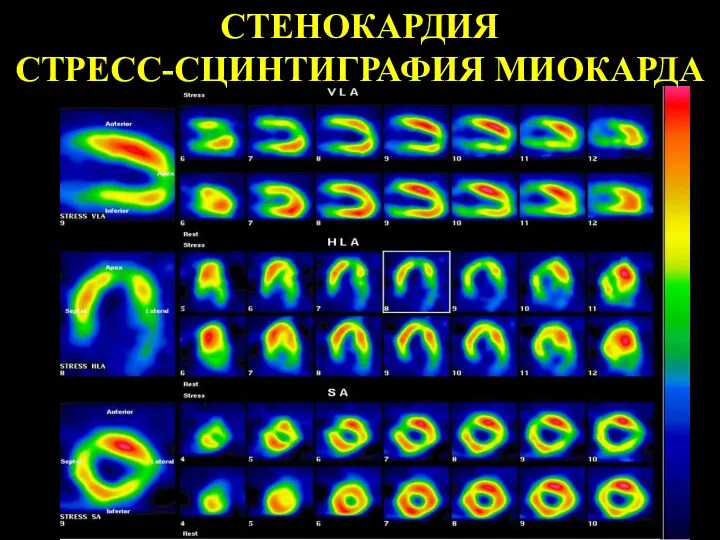 СТЕНОКАРДИЯ СТРЕСС-СЦИНТИГРАФИЯ МИОКАРДА