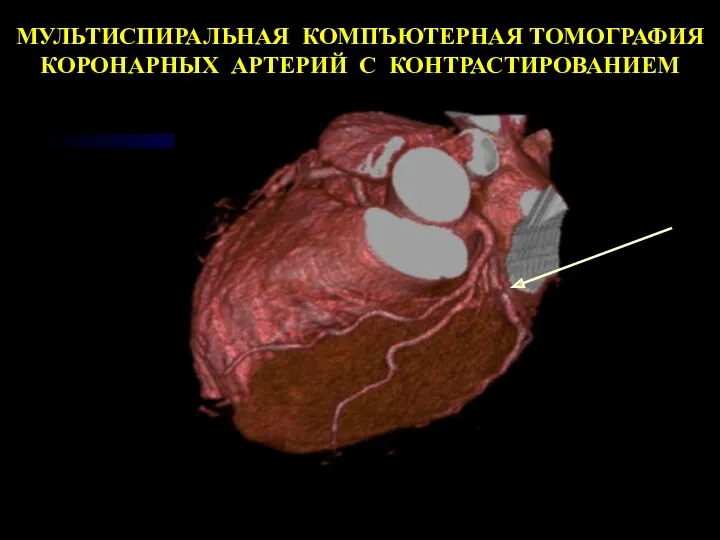 МУЛЬТИСПИРАЛЬНАЯ КОМПЪЮТЕРНАЯ ТОМОГРАФИЯ КОРОНАРНЫХ АРТЕРИЙ С КОНТРАСТИРОВАНИЕМ