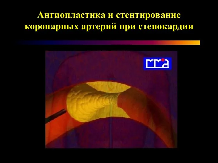 Ангиопластика и стентирование коронарных артерий при стенокардии