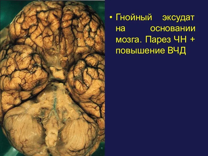 Гнойный эксудат на основании мозга. Парез ЧН + повышение ВЧД