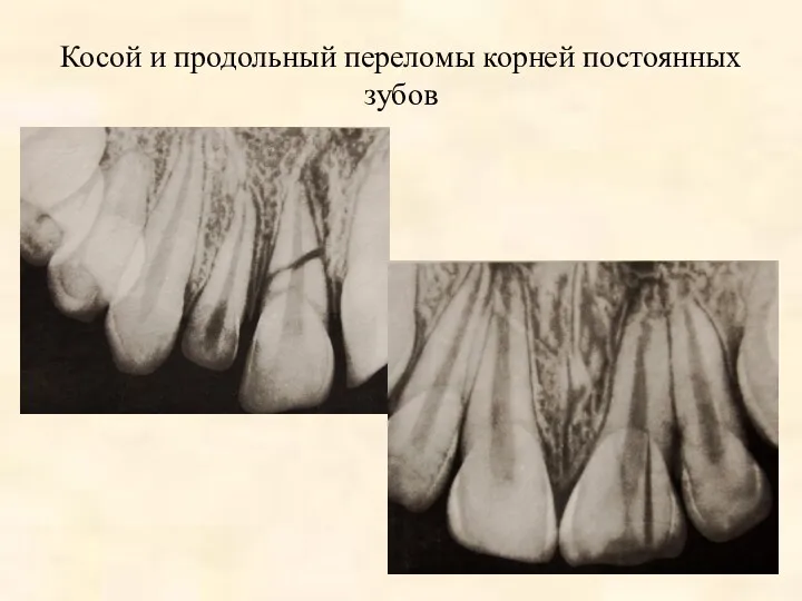Косой и продольный переломы корней постоянных зубов