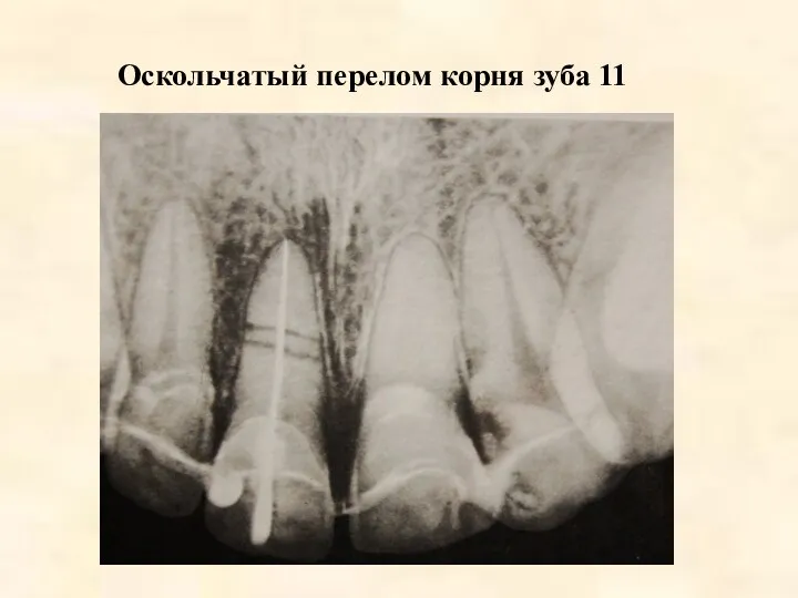 Оскольчатый перелом корня зуба 11