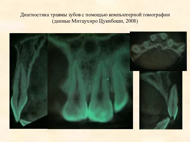 Диагностика травмы зубов с помощью компьютерной томографии (данные Митцухиро Цукибоши, 2008)