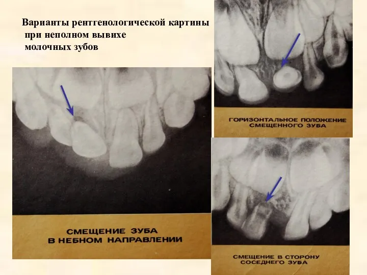 Варианты рентгенологической картины при неполном вывихе молочных зубов