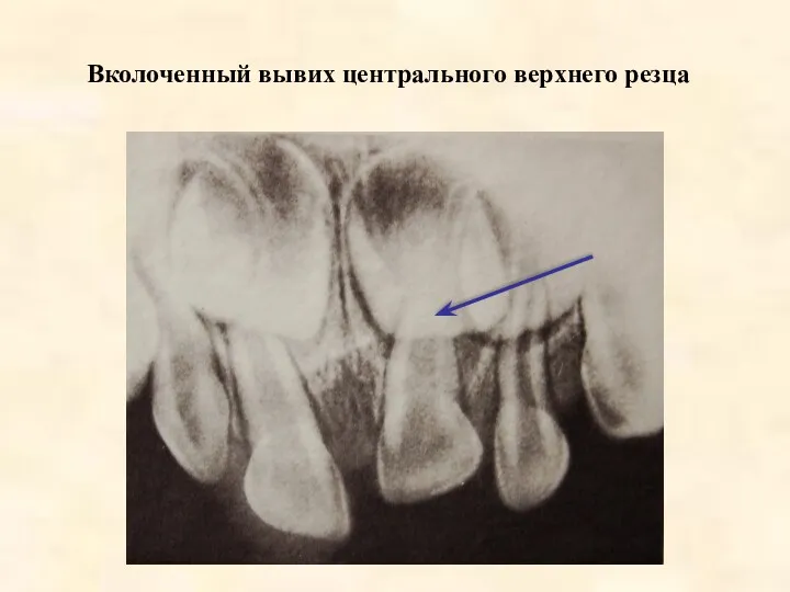 Вколоченный вывих центрального верхнего резца